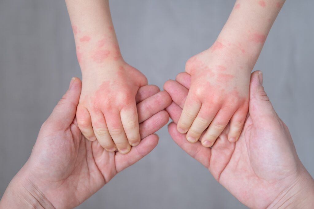 Close up of parent holding child's hands with contact dermatitis on